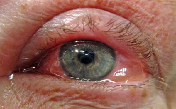 фото аллергического конъюнктивита глаз